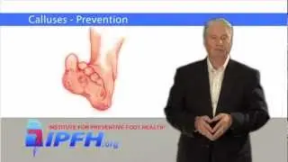 Calluses - Prevention