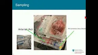 Heart Transplant   Transmedics OCS Heart