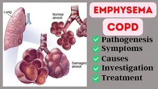 Emphysema(COPD)|Causes|Pathogenesis|Symptoms|Investigation|Treatment|Quick Review|
