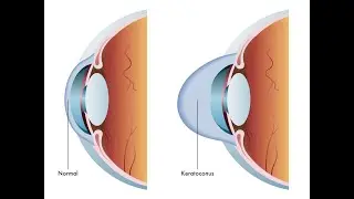 Going blind from Keratoconus.need cornea transplant!!ASAP