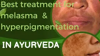 The ultimate treatment & remedy of melasma & hyperpigmentation in Ayurveda everyone should know.