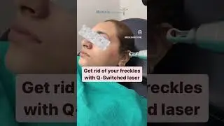 Get rid of your freckles with Q-Switched Laser #medaesxhealthcare #skincare #qswitchlaser