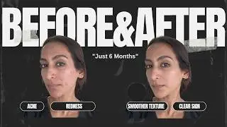 How to Treat ACNE and ACNE SCARS at Home