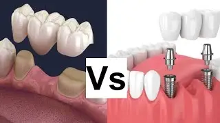 تعويض السن المفقود Bridges vs Implants Dentist's Guide