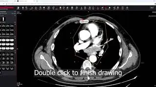 MedDream DICOM Viewer: mark and store the ROI (region of interest)