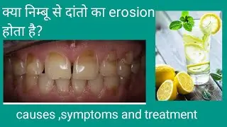 Lemon is good or bad for teeth? teeth erosion,causes,treatment