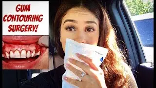 Gum Contouring Surgery/Procedure Vlog | My Experience