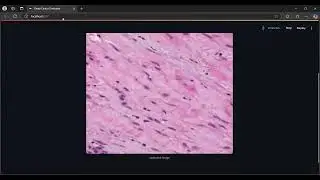 Ovary Cancer Detection System using Deep Learning | AI Project