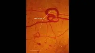 High risk proliferative diabetic retinopathy #eyedisease #retina #ophthalmology