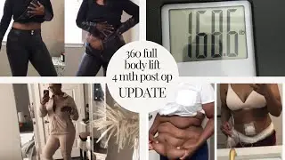 4 Months POST OP - 360 Full Body Lift | Dr. Dry w/ Athenix Body