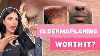 Is dermaplaning worth it for Melanin-rich skin? -Doctor explained