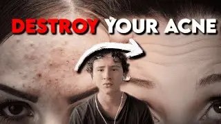 The ONLY video you need for clear skin