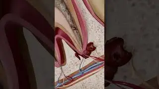 Как развивается хронический апикальный абсцесс? 3D-визуализация с помощью VOKA