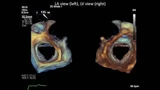 3D TEE of a Normal Mitral Valve