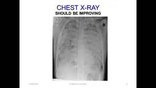 Dr Manny VV ECMO Learn shop part 7: Weaning from V-V ECMO