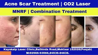 Acne Scar Treatment | CO2 Laser, MNRF | Combination Treatment