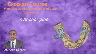 7  Anchor pins in Exoplan
