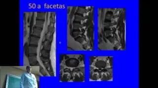 Resonancia Magnética de Columna (parte 2)