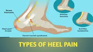 Types of #heelpain || #plantarfasciatis #calcaneumspur #fatpadsyndrome #peronealtendonitis #india