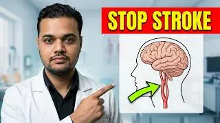 Prevent Stroke Before It Happens | Carotid Artery Stenting #preventstroke #carotid artery stenting
