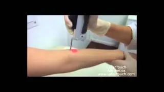 LaserTouch Laser Hair Removal