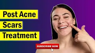 Most Effective Treatment for Post Acne Scar|Dr Amjad Hussain #postacne #scars