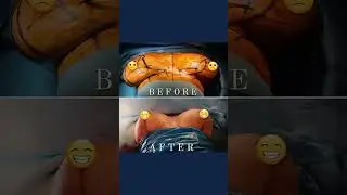 Reductie mamara cu autoaugmentare realizata de Dr. Eugen Turcu