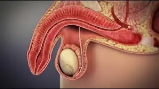 priapism - Know About Diseases