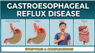 Gastroesophageal Reflux Disease (GERD) Animation | USMLE Step 1 | Pathophysiology, Dx & Treatment