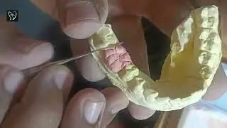 A single Molar build up Porcelain Crown
