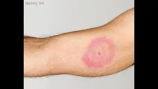 OSCE: Rash (For MBBS, USMLE, MCCQE & PLAB)