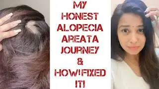 My HONEST ALOPECIA AREATA / HAIR LOSS Journey & How I FIXED it |