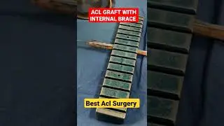 Best ACL Graft and Surgery #youtubeshorts #viral 🔥🔥#shorts #shortsvideo #acl2020  #aclexpert #tumour