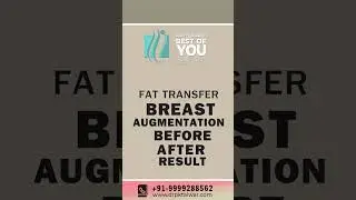 Breast Augmentation with Fat Transfer Result | Before & After Result of Breast Enlargement with Fat