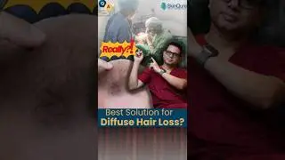 Is hair transplant possible in diffuse hair loss pattern | Dr. Jangid Explains | #shorts