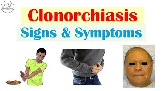 Raw Fish → Bile Duct Parasite: The Hidden Signs and Symptoms of Clonorchiasis