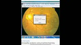Diabetic retinopathy analysis using machine learning DREAM -MATLAB RESEARCH