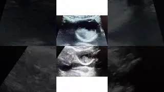 Left iliac fossa pain with lesion in left ovary. #radiology #ultrasound #neetpg
