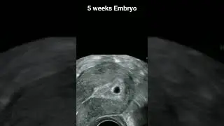 5 Weeks Pregnancy Ultrasound Scan | വയറ്റിലുള്ള കുഞ്ഞു 5 ആഴ്ചയിൽ #shorts #drsita