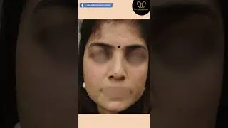 Acne Treatment Delhi | How to Remove Acne Scar | Skin Care Routine #shorts #skincare #acnescars