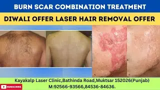 Burn Scar Combination Treatment 🪔🔥💥Diwali Offer 💥🔥🪔 Laser Hair Removal Offer