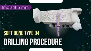 Drilling procedure for XGate Dental X11 and X3 Pure&Porous Implant 5 mm diameter soft bone type D4