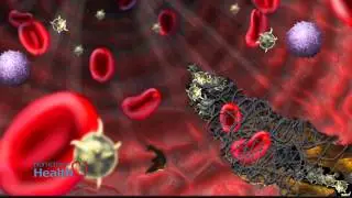 Diabetes and DVT