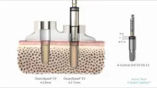 Astra Tech Implant System&trade; EV Guided surgery &ndash; cortical drilling with tube | Dentsply Sirona