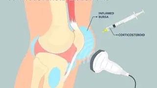 Bursitt = en betent slimpose - forklaring