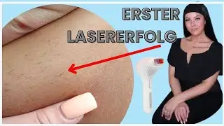 Dauerhafte Haarentfernung mit Laser im Intimbereich | die ersten Haare fallen aus 🤩Q&A