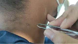 Part 553 PLUCKING INGROWN HAIR AND SPIT WHITE HAIR