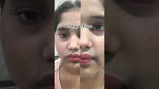 Get V-Shape Face #artist #skincare #carbonlaserfacial #rainingday #haircare #haircare #botoxfacial #