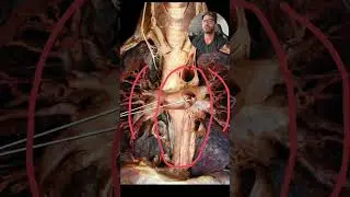 Are these blood vessels carrying oxygenated or deoxygenated blood? #Medical #Doctor #medicine #md