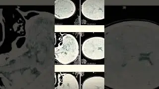 CT Scan of Common Cold 🤧 | What&rsquo;s Really Happening Inside? #facts